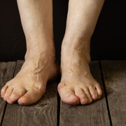 Can Hammer Toe Be Fixed? How to Effectively Fix Hammer Toes With Tape - Audio Blog