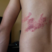 Purpura vs. Petechiae Rash: How to Tell Them Apart & What They Mean for Your Health - Audio Blog
