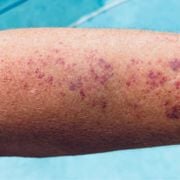 Petechiae vs. Purpura vs. Ecchymosis: Their Key Differences Explained - Audio Blog