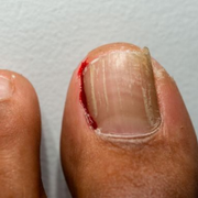 What Is an Ingrown Toenail? What Does It Look Like? - Audio Blog