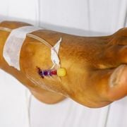 Expert Tips on What Is the Fastest Way to Heal a Leg Ulcer - Audio Blog