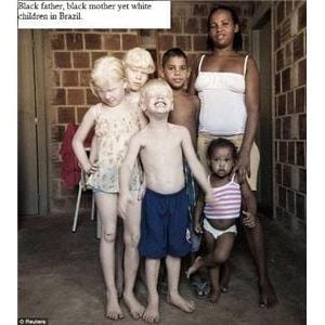 Bible Leprosy Albinism Vitiligo And The Origin Of White Skin By 5 Smooth Stones Mixcloud