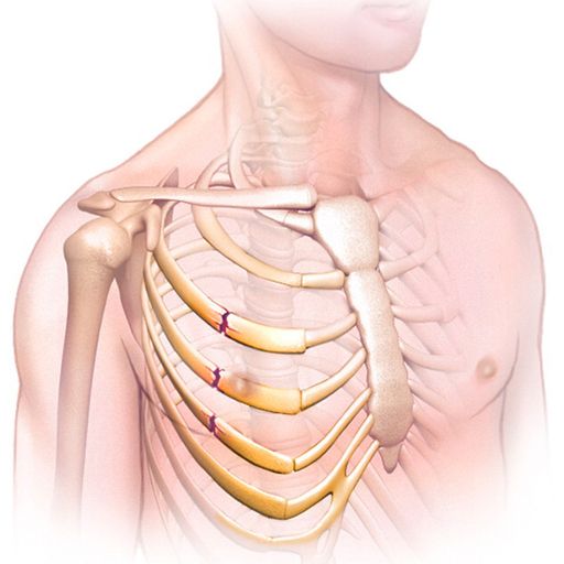 No Air: The Broken Rib Collection Addendum