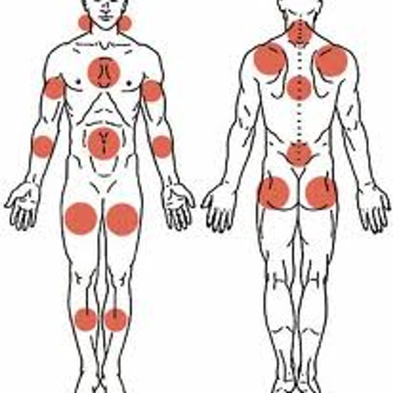 Точки напряжения мышц. Болевые точки при фибромиалгии. Фибромиалгия триггерные точки. Болевые триггерные точки схема. Триггерные точки при фибромиалгии.