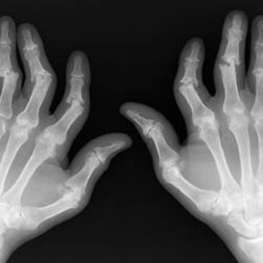 Псориатический артрит кистей рук