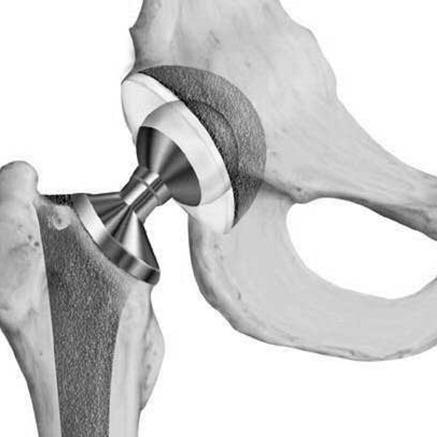 Замена сустава шейки бедра